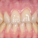 Il trattamento di copertura radicolare nei casi di recessioni multiple