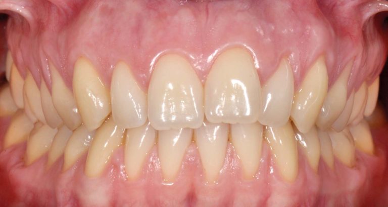 Il trattamento di copertura radicolare nei casi di recessioni multiple