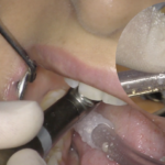 Riabilitazioni di II classe: diagnosi precoce e restauri minimamente invasivi classe_diagnosi_interprossimali