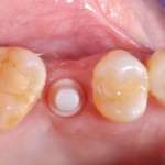 Utilizzo di impianti in ceramica one-piece nella pratica clinica quotidiana. Case report