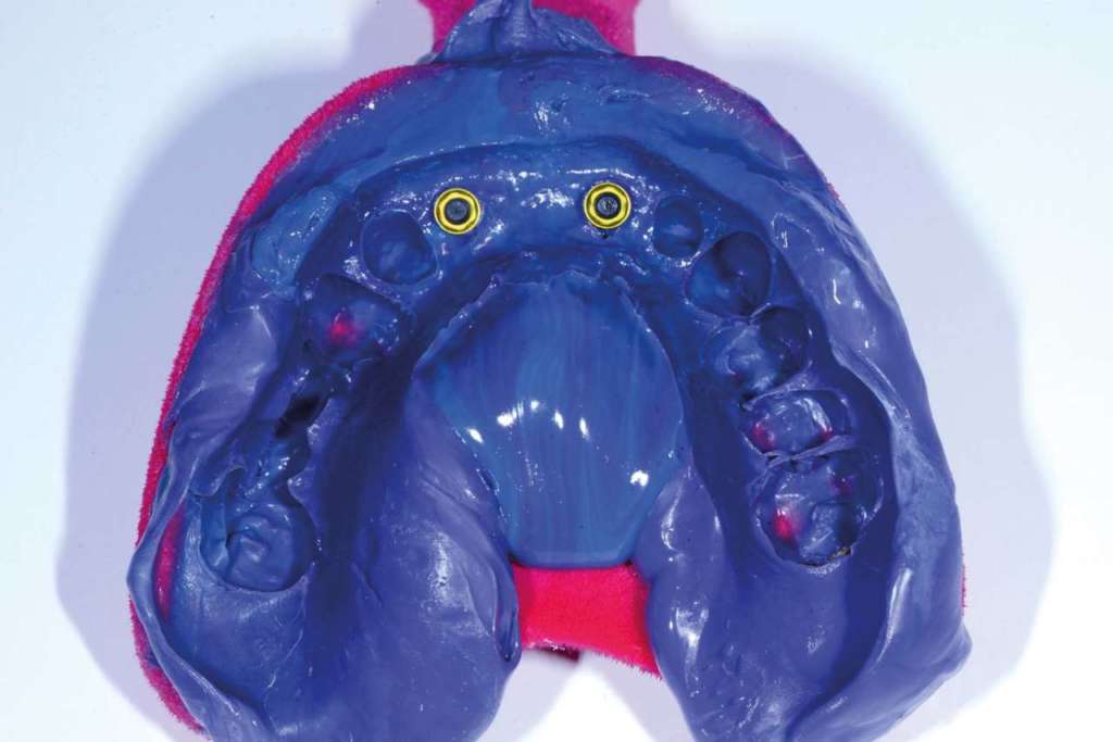 Fig. 1 Impronta eseguita per riabilitazione su impianti