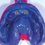 Stabilità dimensionale dei siliconi e precisione in relazione alla tecnica di impronta Fig. 1 Impronta eseguita per riabilitazione su impianti