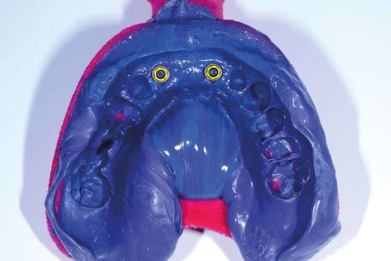 Impatto dell'altezza del collare dell'abutment nella biomeccanica implantare