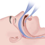 Esistono effetti collaterali dei dispositivi MAD nel trattamento delle OSAS?