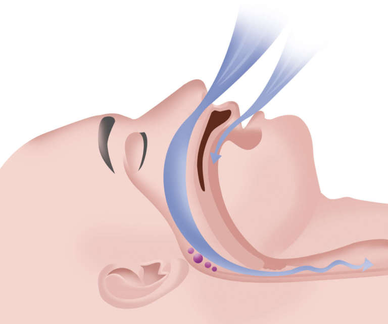 Esistono effetti collaterali dei dispositivi MAD nel trattamento delle OSAS?