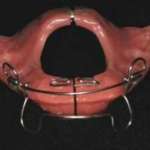 Un apparecchio funzionale di scelta in corso di terapia ortodontica: l’attivatore “ellenizzato” (E/A)