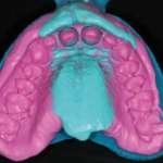 L’adesione del materiale d’impronta su un portaimpronta ricoperto con Flock PA66
