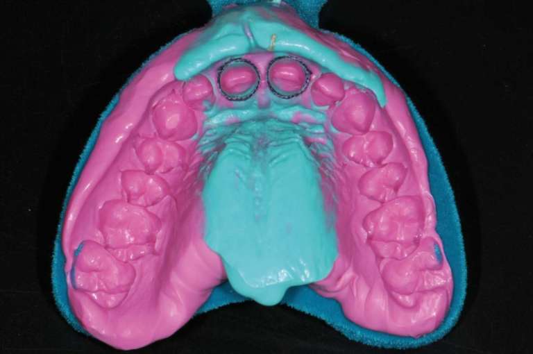 L’adesione del materiale d’impronta su un portaimpronta ricoperto con Flock PA66