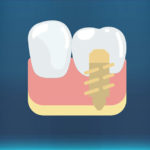 Stato dell’arte del workflow digitale in implantoprotesi