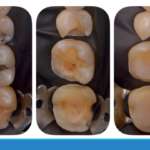 Intarsi in disilicato di litio: la preparazione cavitaria è in grado di influenzare il rischio fratturativo intarsi_corso_ecm