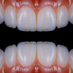 Conseguenze dello scaling sulla superficie implantare