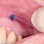 Diagnostica differenziale delle lesioni pigmentate del cavo orale