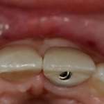 Tecnica di preservazione della cresta e riabilitazione con impianto nella zona estetica Case report