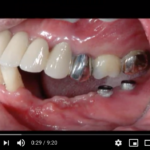 Sandwich technique nella riabilitazione implantare di siti a dimensione verticale deficitaria DM_il dentista moderno_sandwich technique