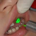 I laser in odontoiatria pediatrica