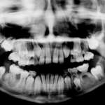 Le manifestazioni sindromiche del cavo orale come diagnosi nella crescita del paziente