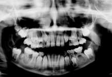 Le manifestazioni sindromiche del cavo orale come diagnosi nella crescita del paziente