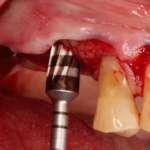 Rialzo del seno mascellare per via crestale mediante osseodensificazione