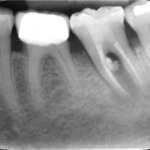 Lesione endo-parodontale complicata da una perforazione da stripping. Case report