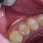 Un nuovo test diagnostico per la parodontite apicale acuta