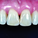 Il canale della vite angolato realizzato con tecnologia CAD/CAM: un fattore di rischio per complicanze tecniche?