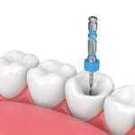 Analisi del tempo di lavorazione di due sistemi reciprocanti con file singolo durante la preparazione di canali radicolari curvi