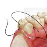 La sutura in chirurgia orale, come influenza la guarigione