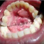 Caratteristiche cliniche ed epidemiologiche del fibroma traumatico orale