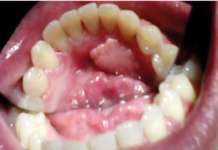 Caratteristiche cliniche ed epidemiologiche del fibroma traumatico orale