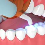 Gli effetti della polimerizzazione nella restaurativa moderna