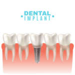 Correzioni difetti estetica DM_il-dentista-moderno_impianti-inclinati_impianti-angolati