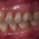 Impianto post-estrattivo in settore latero-posteriore: tecnica chirurgica mininvasiva