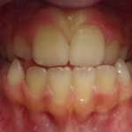 I disturbi respiratori del sonno pediatrici: un “ponte” fra l’odontoiatria e la medicina