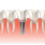 Fattori predisponenti fallimento implantare precoce fallimento impianti precoci Il dentista-moderno_impianti angolati