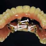 Una soluzione innovativa per la protesi fissa