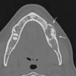 Displasia fibrosa craniofacciale: patogenesi, diagnosi e opzioni terapeutiche