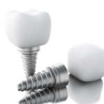 Supporto scientifico alla bone augmentation in implantologia postestrattiva DM_il-dentista-moderno_implantologia-immediata.jpg