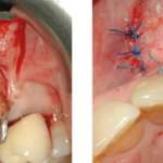 Rigenerazione perimplantare con sostituto osseo e membrana corticale di origine equina un caso clinico