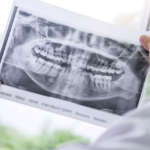 Guadagno osseo medio nella rigenerazione ossea verticale: risultati di una revisione sistematica DM_il-dentista-moderno_rigenerazione-ossea-verticale