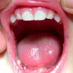 Assunzione di zuccheri in eccesso – Malattia cariosa nel bambino e implicazioni sistemiche nell’adulto