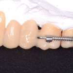 L’ortodonzia mini-invasiva in caso di prossimità radicolari Case Report