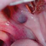 Problemi di diagnosi differenziale delle neoformazioni salivari intraorali e delle labbra