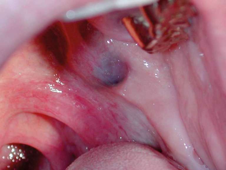 Problemi di diagnosi differenziale delle neoformazioni salivari intraorali e delle labbra