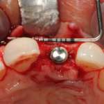 Che cosa si intende per implantologia protesicamente guidata PGR_posizionamento_implantare_protesicamente_guidato