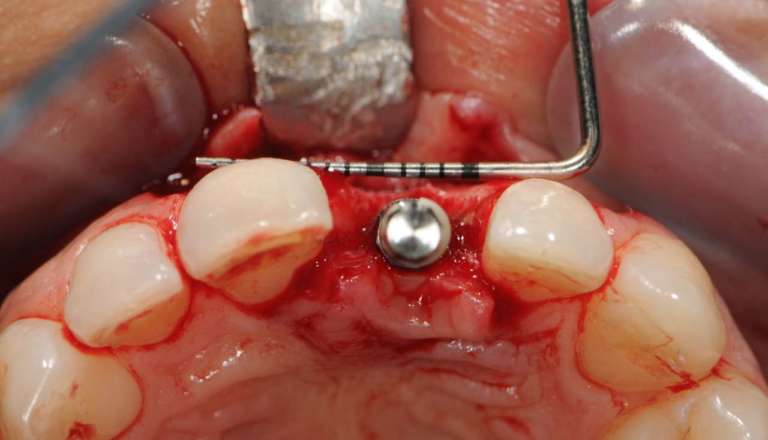 Che cosa si intende per implantologia protesicamente guidata