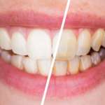 Sbiancamento in office e domiciliare