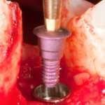 Implantologia a carico immediato: intervista a Massimo Cianci