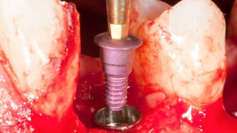 Implantologia a carico immediato