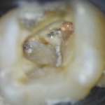 Il ritrattamento endodontico ortogrado