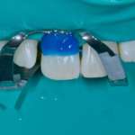 La diga di gomma: “tips and tricks” di un imperativo clinico